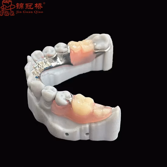 Prótese com estrutura metálica removível de alta qualidade